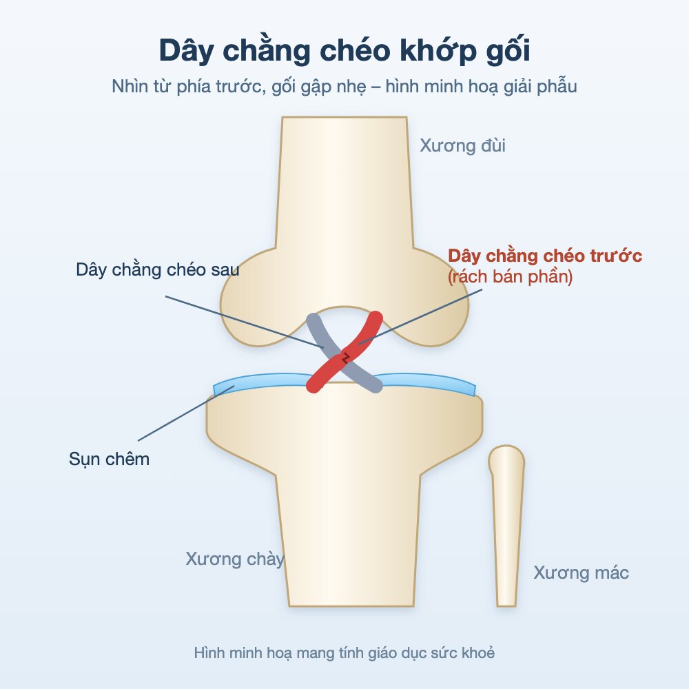 Hình minh hoạ giải phẫu dây chằng chéo trước và chéo sau khớp gối