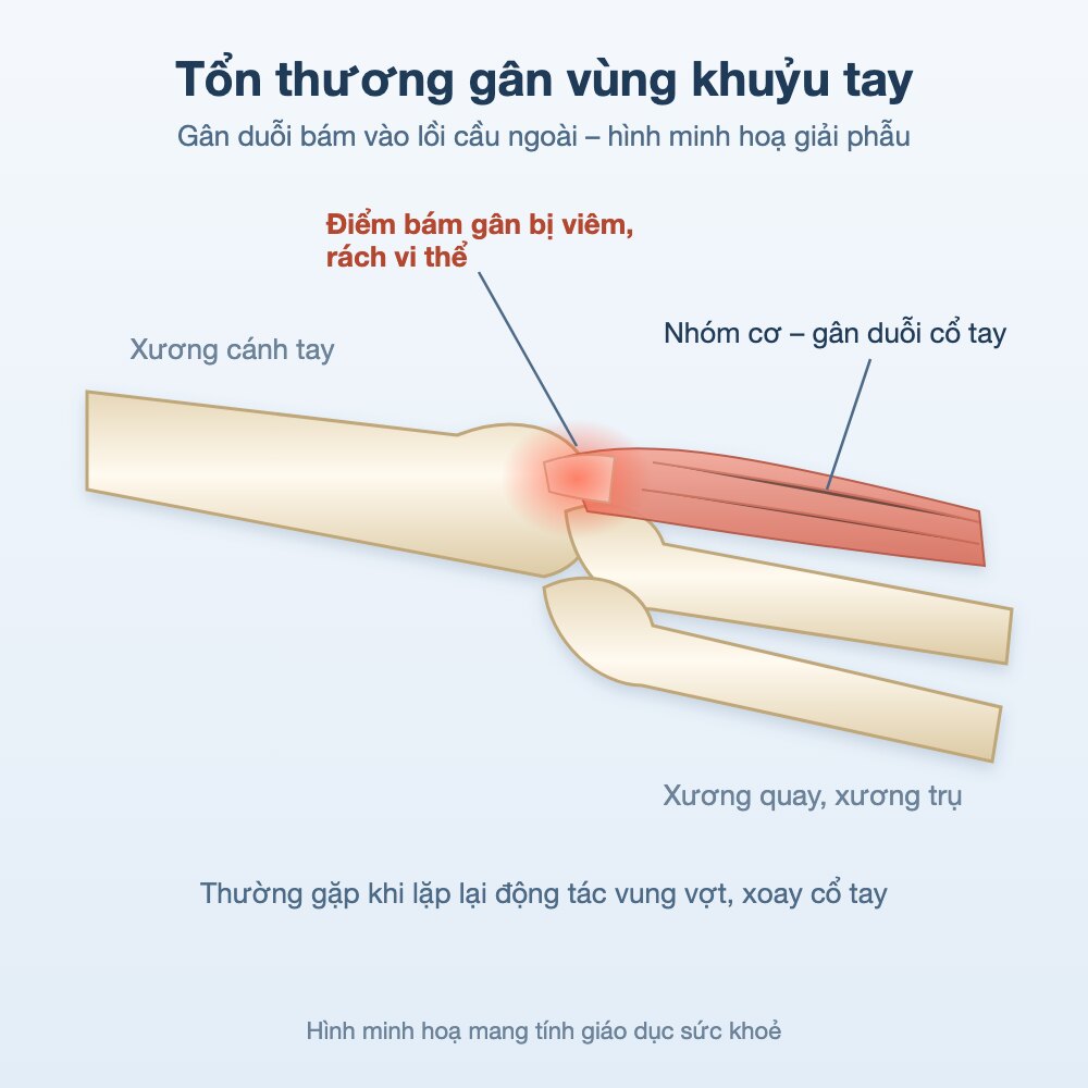 Hình minh hoạ giải phẫu điểm bám gân duỗi vùng khuỷu tay