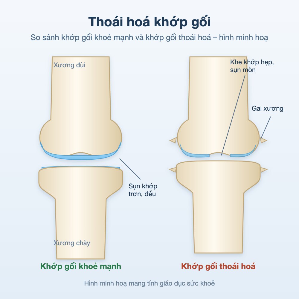 Hình minh hoạ so sánh khớp gối khoẻ mạnh và khớp gối thoái hoá