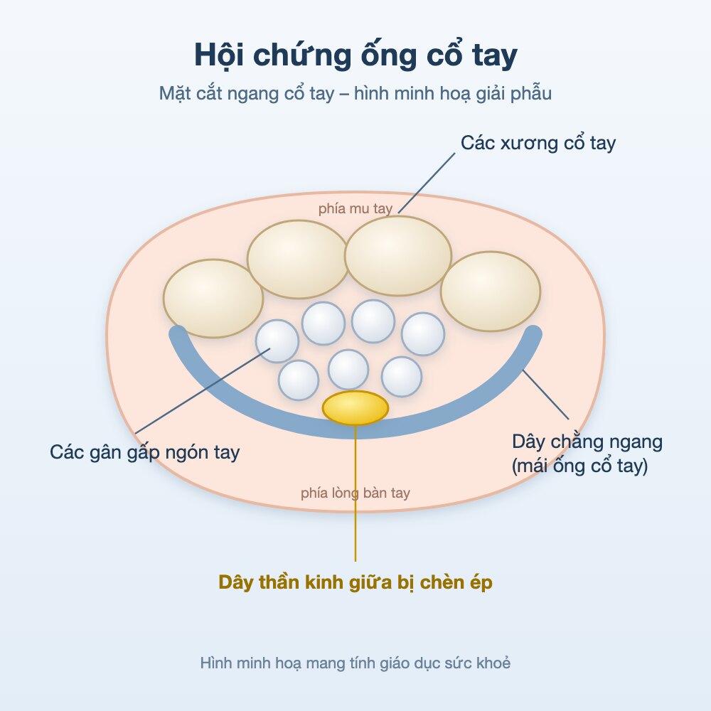 Hình minh hoạ giải phẫu mặt cắt ngang ống cổ tay và dây thần kinh giữa
