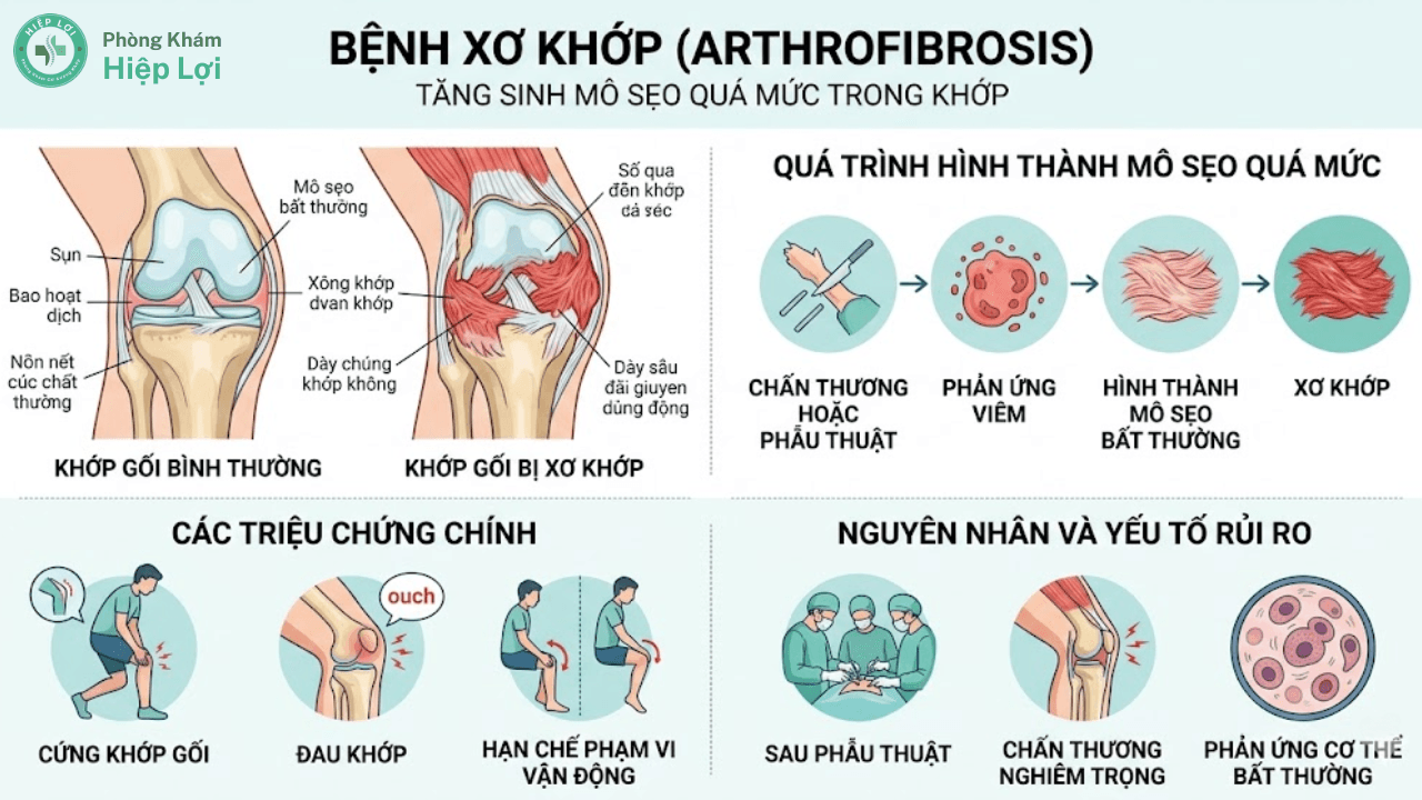 GIẢI MÃ BỆNH XƠ KHỚP: PHƯƠNG PHÁP CHẨN ĐOÁN VÀ PHỤC HỒI CHỨC NĂNG CHUẨN Y KHOA - Phòng khám Hiệp Lợi