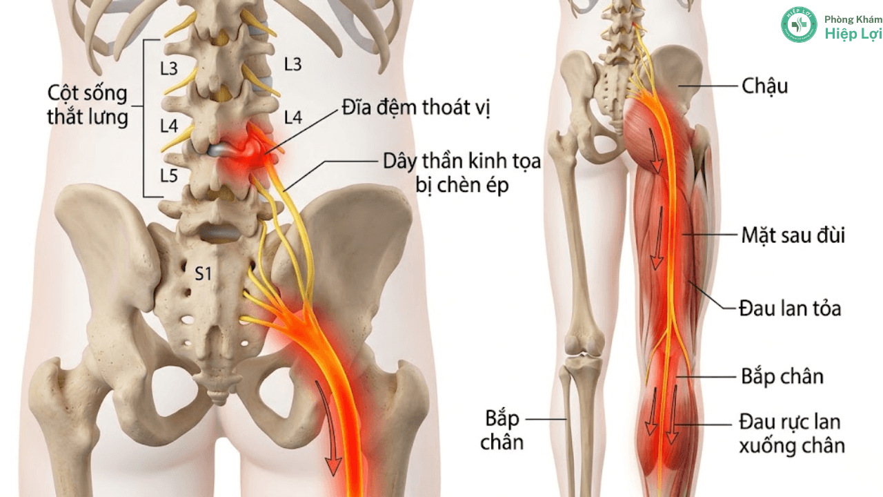 Châm Cứu Đau Thần Kinh Tọa Có Thực Sự Hiệu Quả Không? - Phòng khám Hiệp Lợi