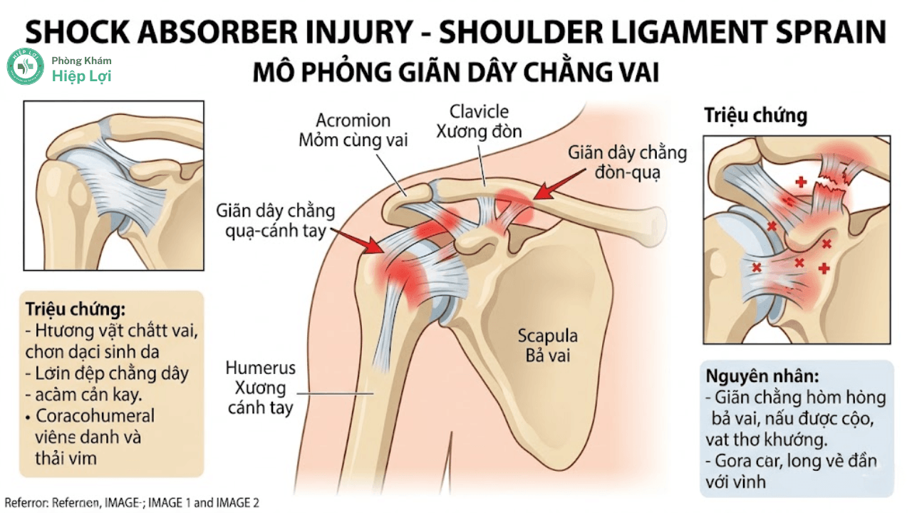 Giãn Dây Chằng Vai: Nguyên Nhân, Triệu Chứng Và Cách Xử Lý