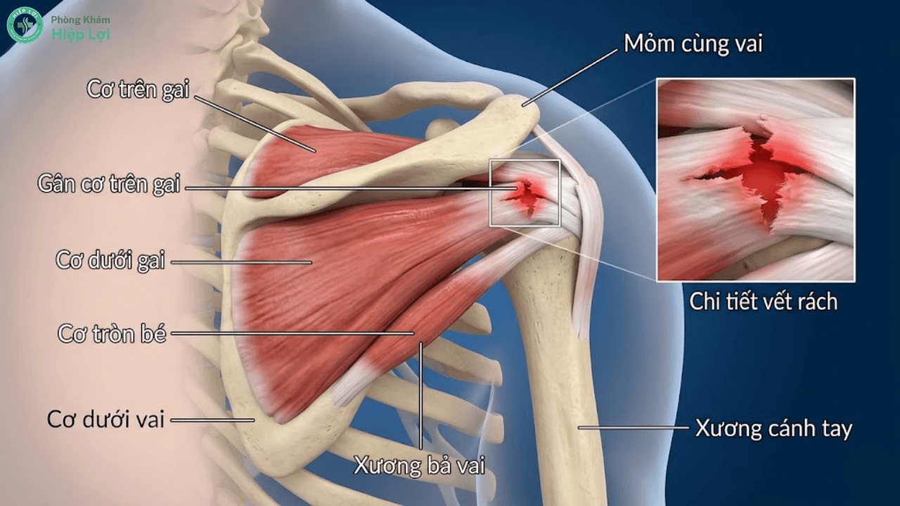 Rách Cơ Chóp Xoay Là Gì? Nguyên Nhân, Triệu Chứng Và Cách Điều Trị Hiệu Quả