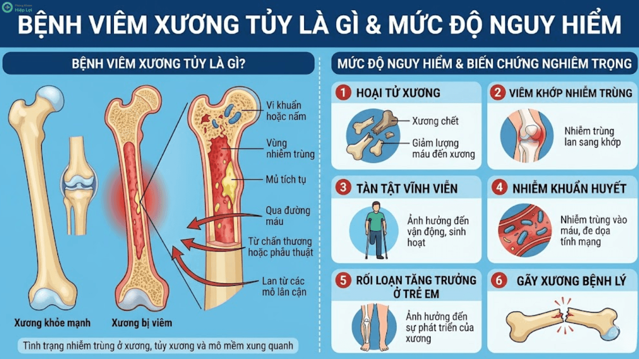 Giải Đáp Y Khoa: Bệnh Viêm Xương Tủy Có Thể Điều Trị Dứt Điểm Được Hay Không? - Phòng khám Hiệp Lợi
