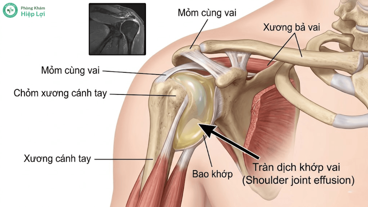 Điều Trị Và Chăm Sóc Bệnh Nhân Tràn Dịch Khớp Vai - Phòng khám Hiệp Lợi