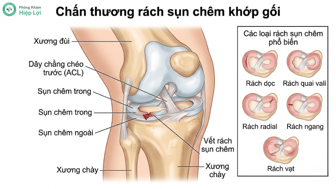 Điều Trị Rách Sụn Chêm Khớp Gối Và Phục Hồi Chức Năng - Phòng khám Hiệp Lợi