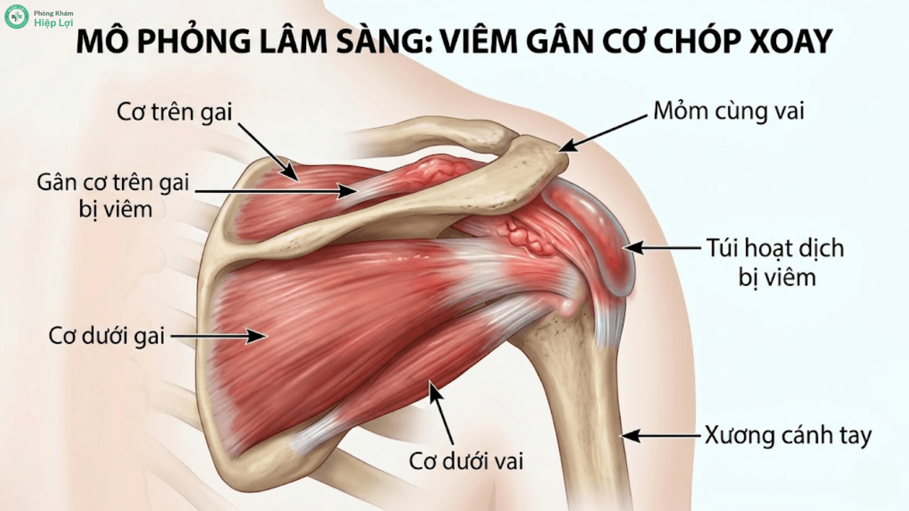 Cảnh Báo: Những Đối Tượng Nào Có Nguy Cơ Bị Viêm Quanh Khớp Vai Cao Nhất? - Phòng khám Hiệp Lợi