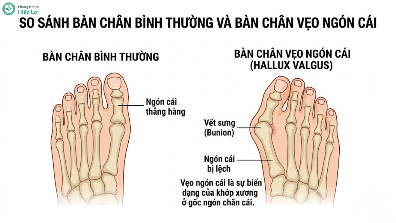 Sưng Ngón Chân Cái Và Biến Dạng Bunion: Nguyên Nhân, Triệu Chứng Và Cách Chữa Trị - Phòng khám Hiệp Lợi