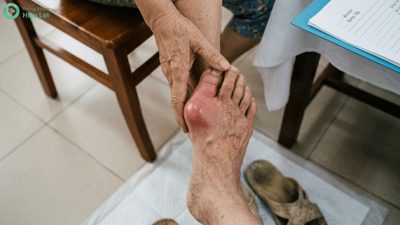 Sưng Ngón Chân Cái Và Biến Dạng Bunion: Nguyên Nhân, Triệu Chứng Và Cách Chữa Trị