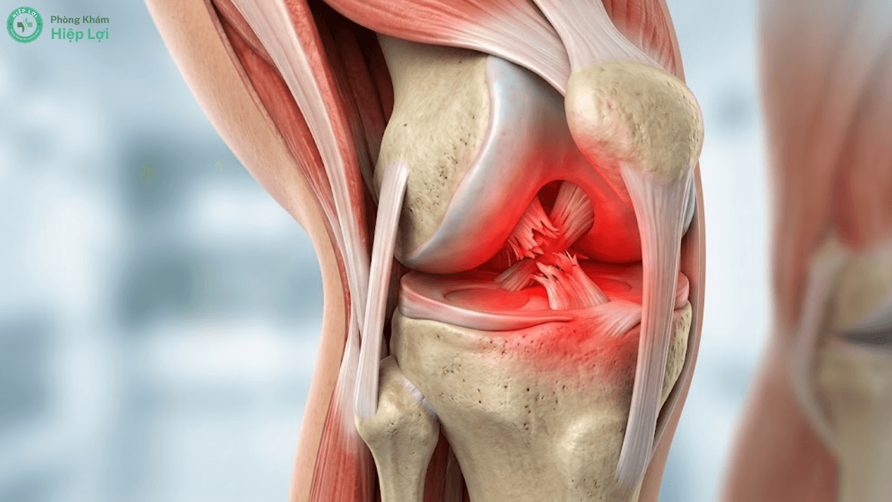Đứt Dây Chằng Khớp Gối Có Đáng Lo Ngại Không? Nguyên Nhân, Triệu Chứng Và Cách Điều Trị