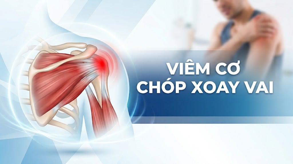 Viêm cơ chóp xaoy vai