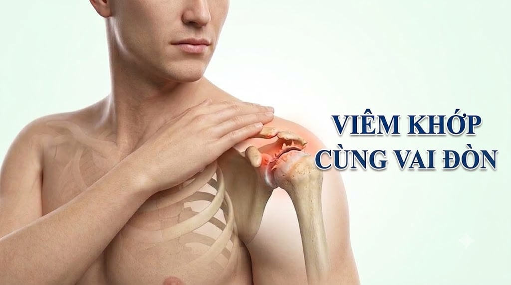 Viêm khớp cùng vai đòn gây đau nhói tại đỉnh vai