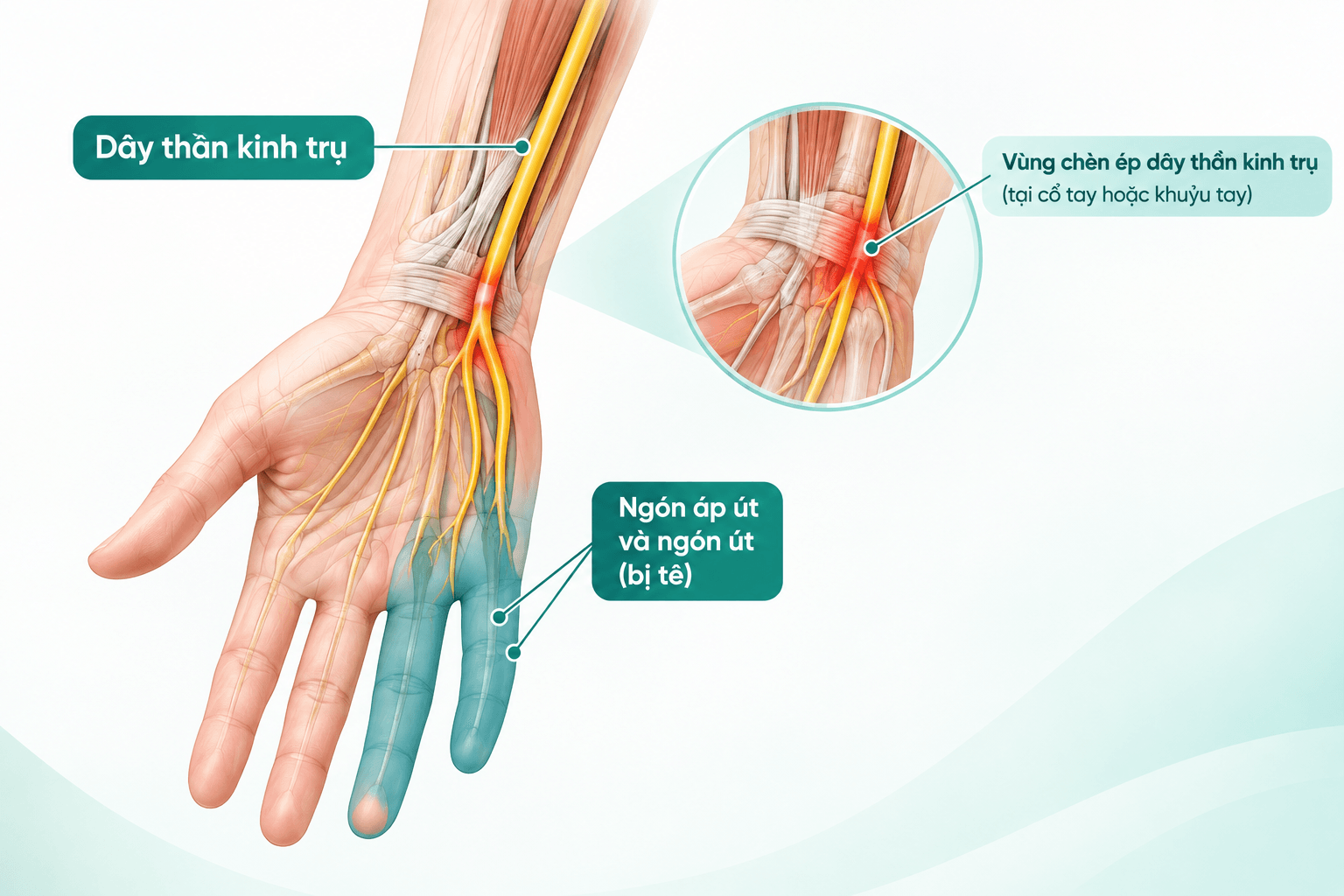 Tê Ngón Áp Út Và Ngón Út: Nguyên Nhân, Cách Điều Trị Và Khi Nào Cần Đi Khám? - Phòng khám Hiệp Lợi